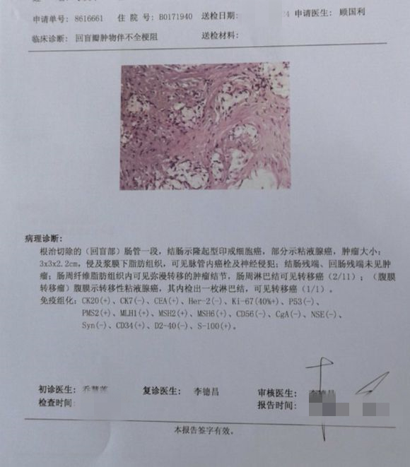 结肠印戒细胞癌